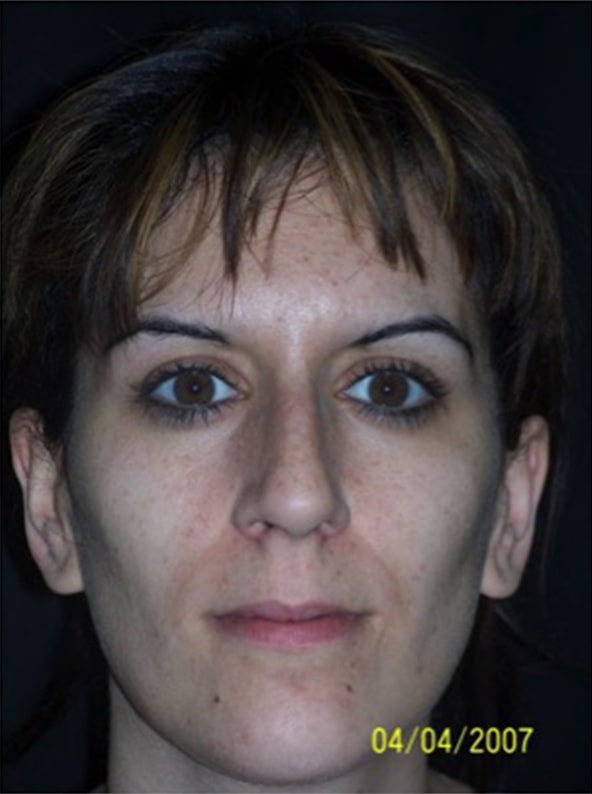Patient before Nonsurgical Rhinoplasty