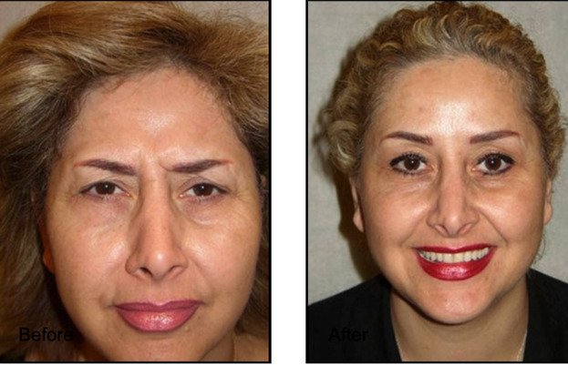 Female patient before and after Botox brow lift
