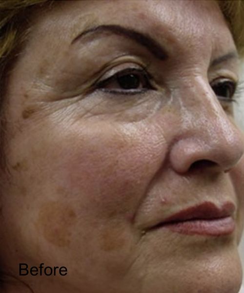 Patient before CO2 laser Skin Resurface Treatment