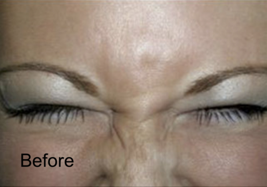 Patient before Neurotox for Wrinkles
