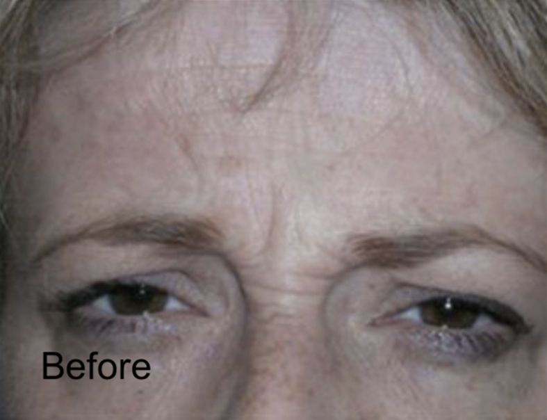 Patient before Neurotox for Wrinkles