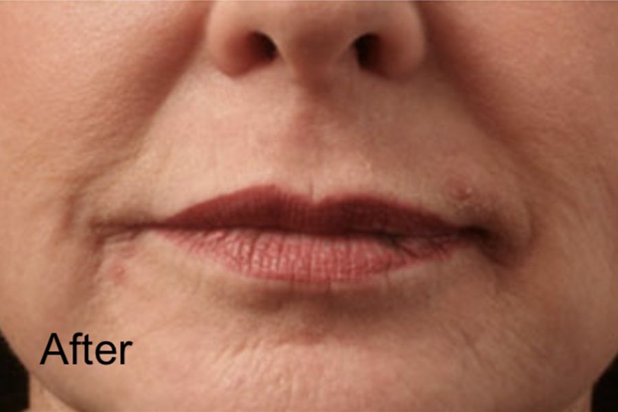 Patient after CO2 laser Skin Resurface Treatment