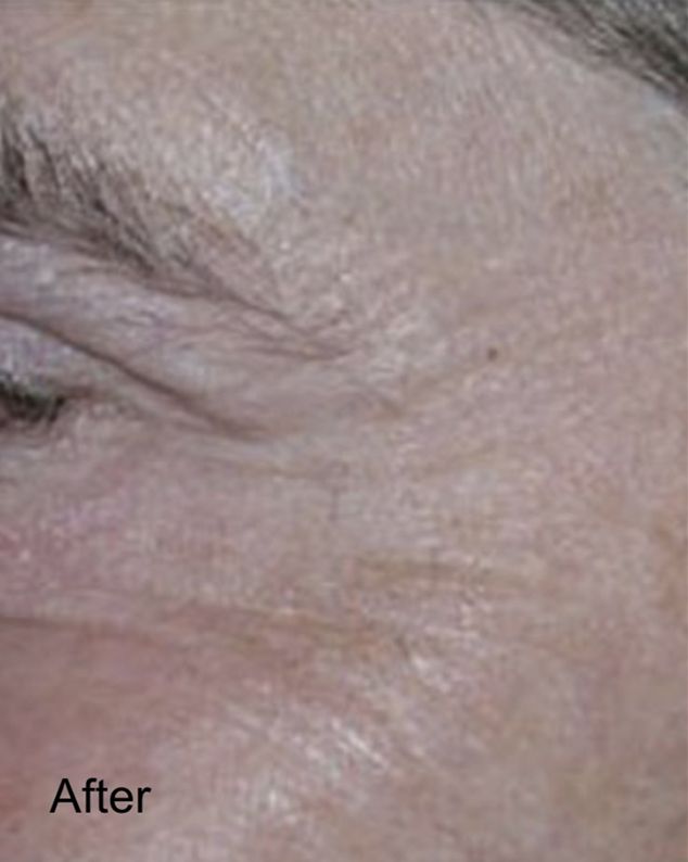 Patient after Neurotox for Wrinkles