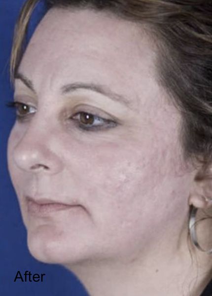 Patient after CO2 laser Skin Resurface Treatment