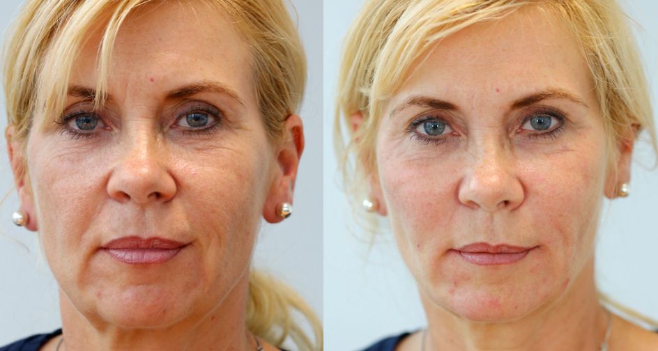 Female patient before and after 3D Vector Non-Surgical Facelift