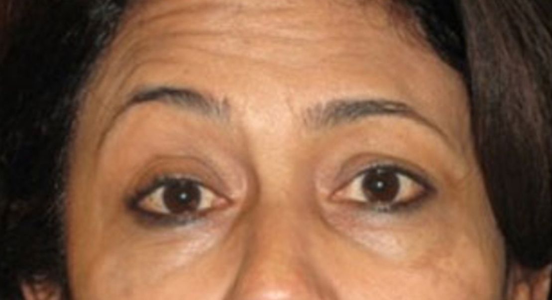 Patient before Non-Surgical Neurotox Browlift