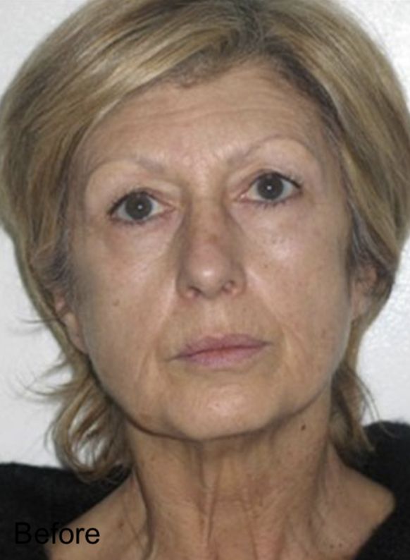 Female patient before Nonsurgical Cheeks Lift and Non-Surgical Fat Face Lift