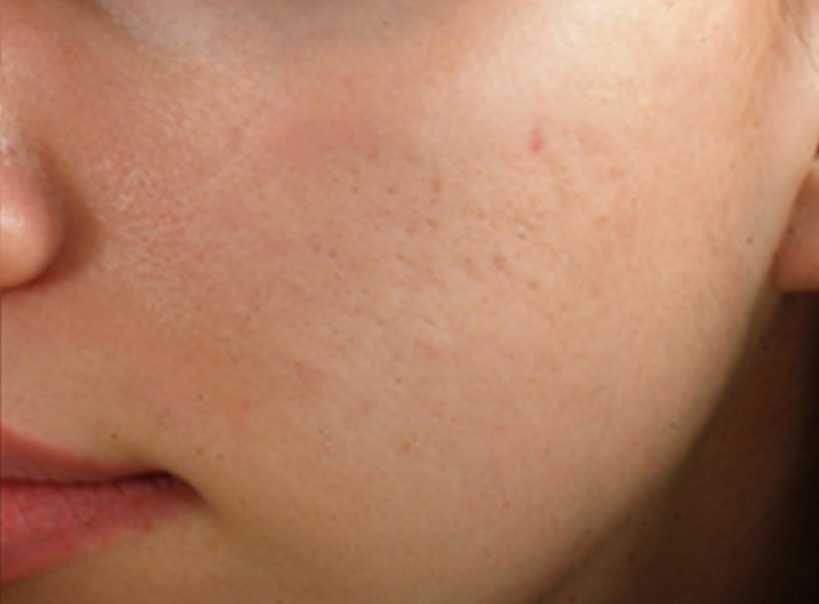 Patient after Microneedling