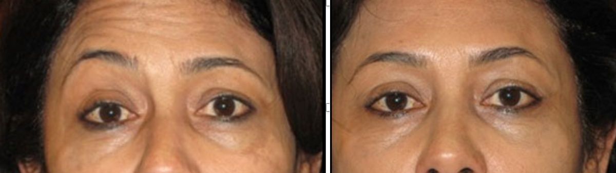 Female patient before and after nonsurgical browlift with Botox