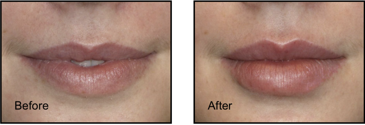 Patient's lips before and after lip filler treatment