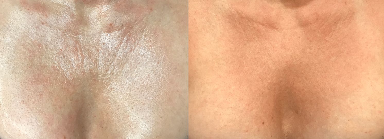 Woman's chest before and after non-surgical rejuvenation of decollete wrinkles