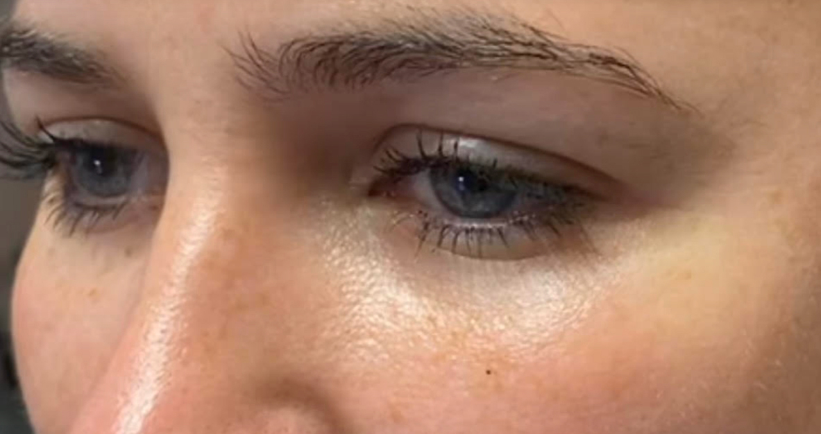 Patient after Nonsurgical Browlift