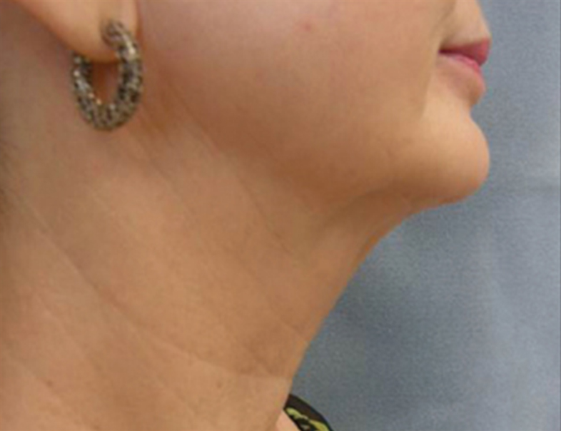 Patient after Relift Skin Tightening and Fat Melting Lower Face