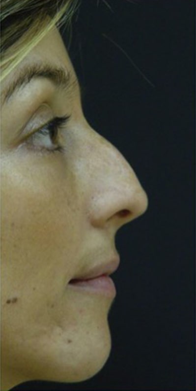 Female patient before Nonsurgical Rhinoplasty