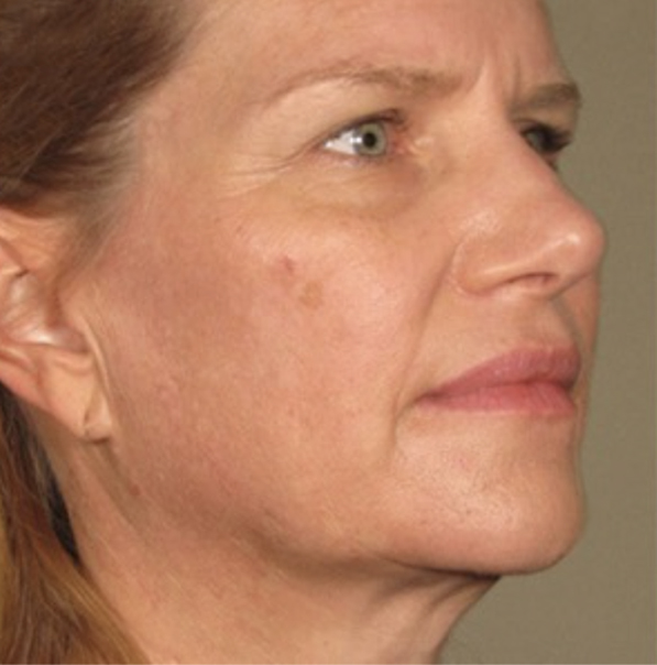 Patient after Viora VST Skin Tightening