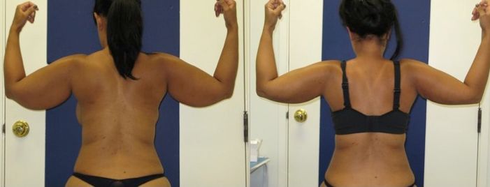Female patient before and after arms liposuction