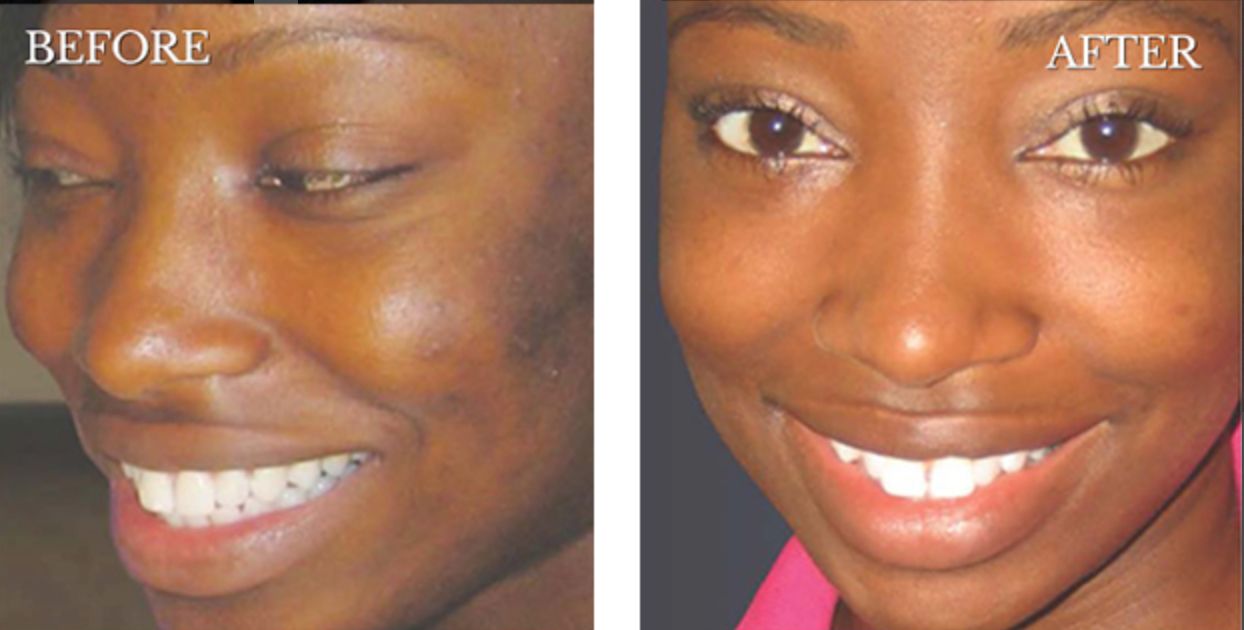 Female patient's face before and after chemical peel treatment