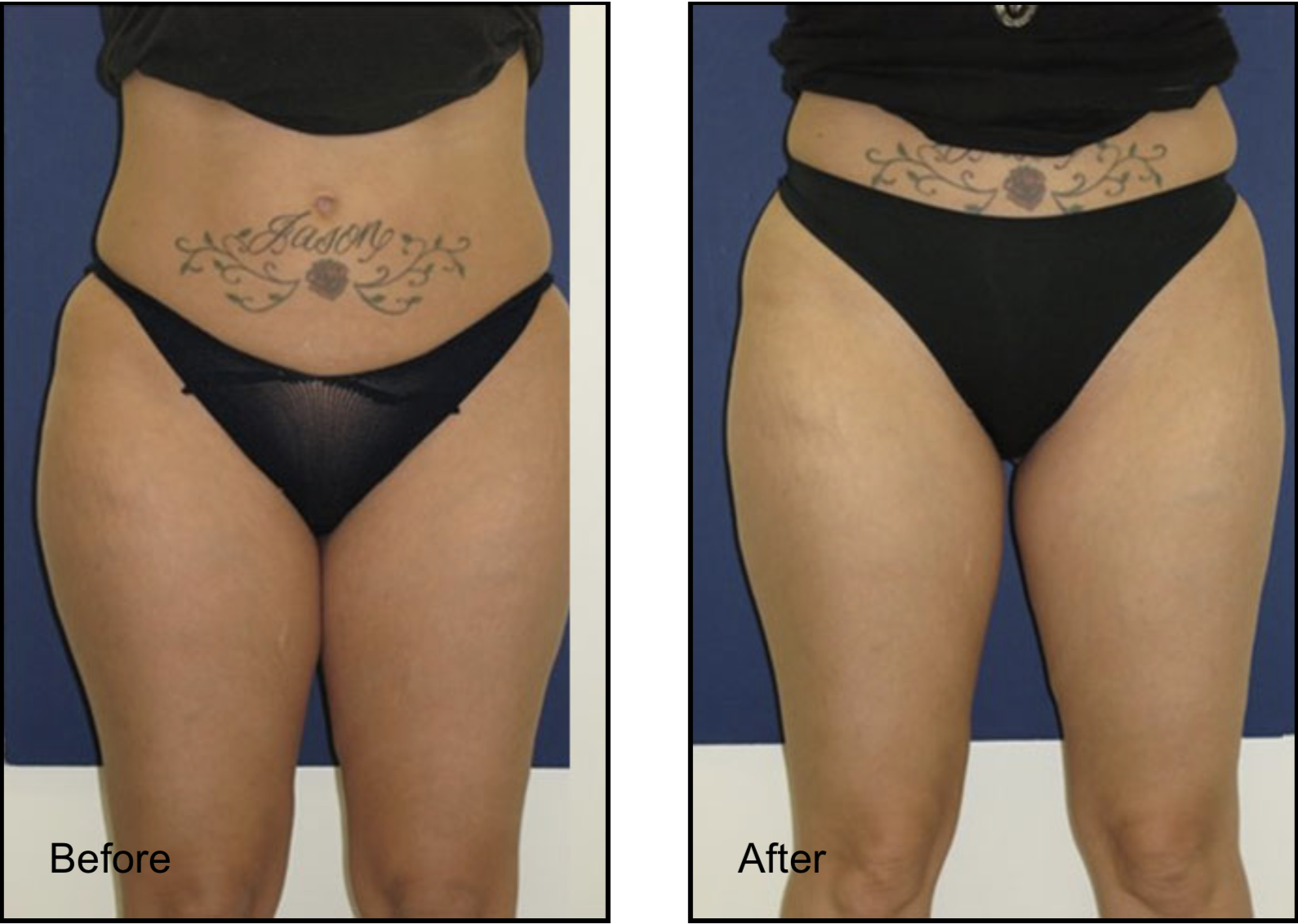 Female patient before and after thighs lipo