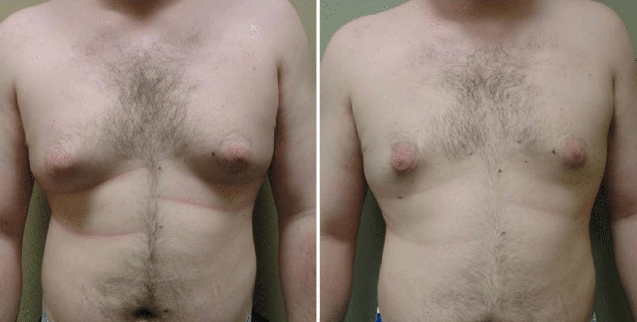 Patient's chest before and after male breast liposuction.