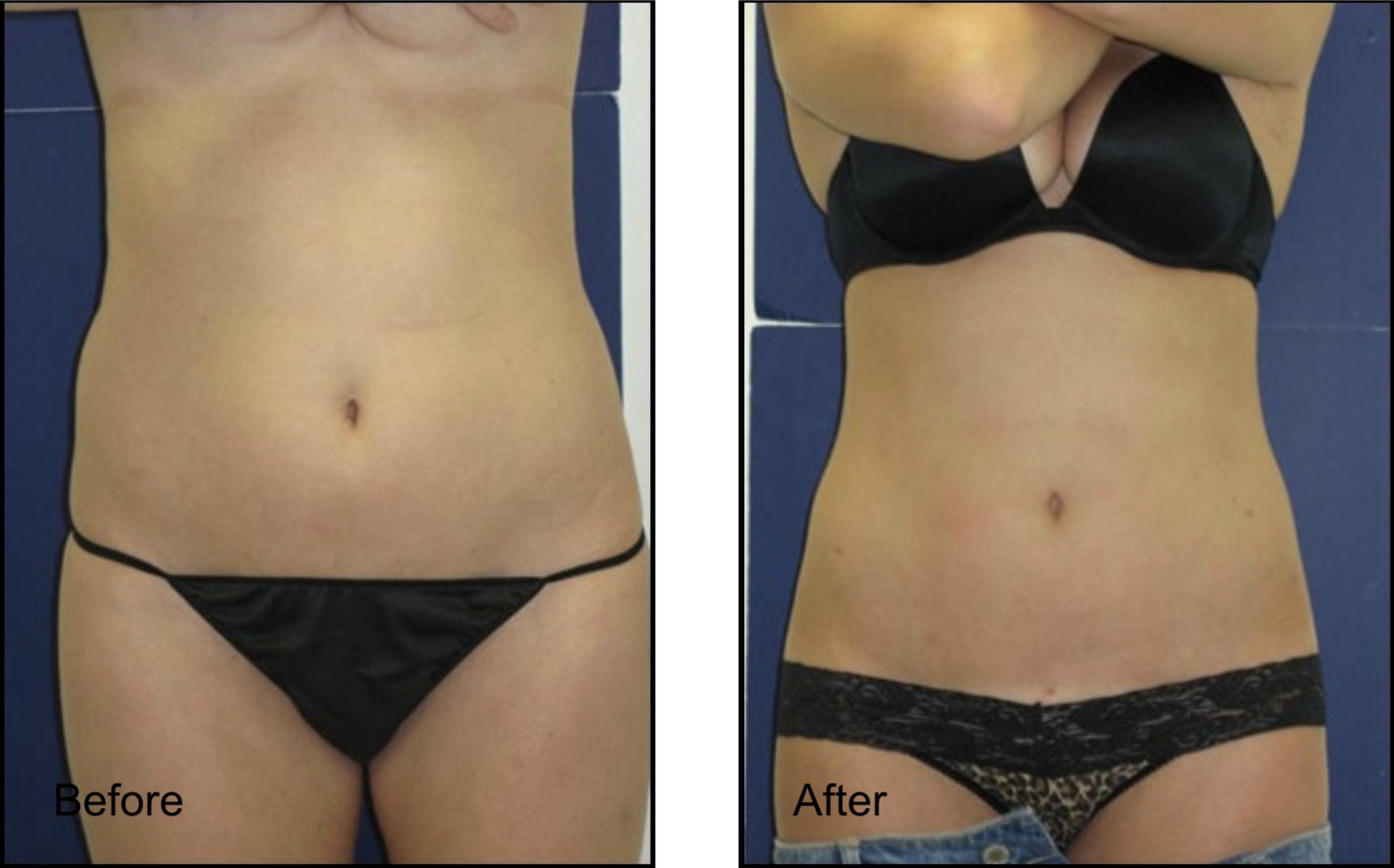 female patient before and after non-surgical abdominal lipo