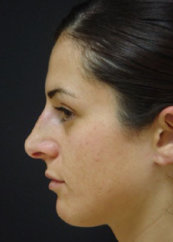 Patient after Nonsurgical Rhinoplasty