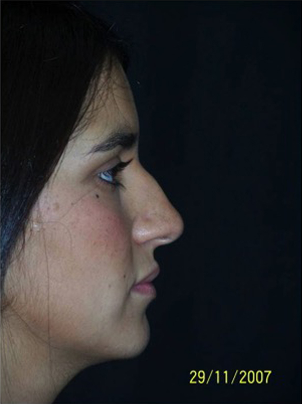 Patient before Nonsurgical Rhinoplasty