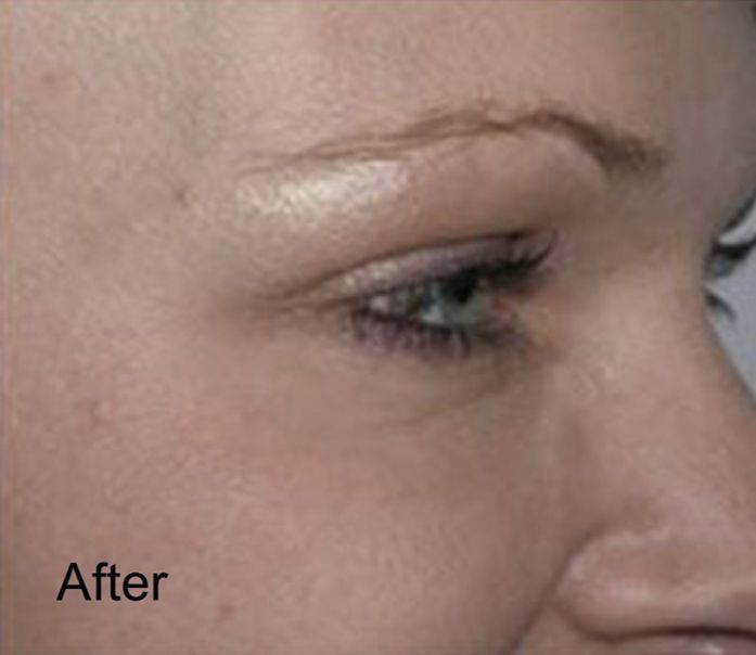Patient after Neurotox for Wrinkles