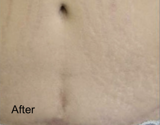 Patient after C02 Laser Skin Resurfacing