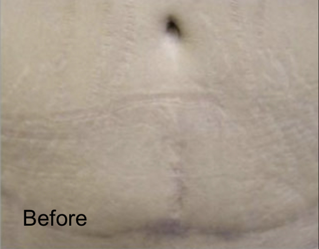 Patient before C02 Laser Skin Resurfacing