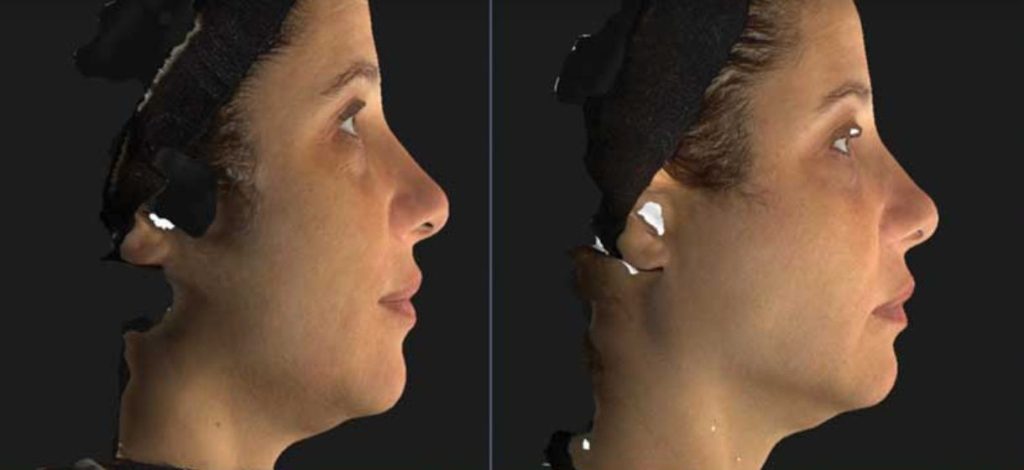 Los Angeles Nefertiti Neck/Lower Face Lift With Neurotox® | Beverly Hills