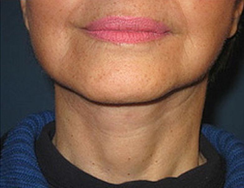 Patient after Neurotox For Turkey Neck and Neck Band Treatment