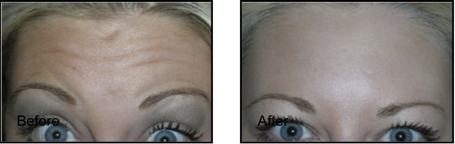 Patient's forehead before and after Botox for wrinkle treatment