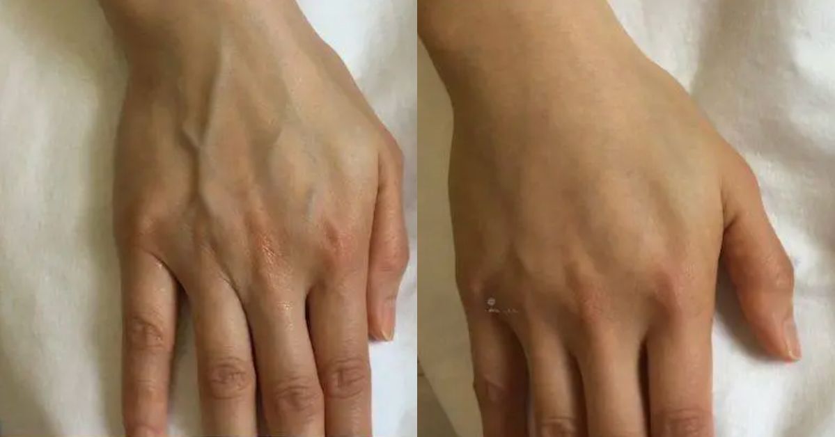 Hands before and after non-surgical hand rejuvenation