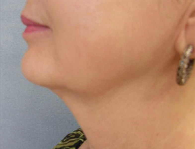 Patient after Relift Skin Tightening and Fat Melting Lower Face