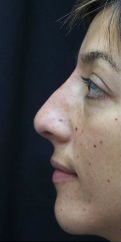 Female patient after Nonsurgical Rhinoplasty
