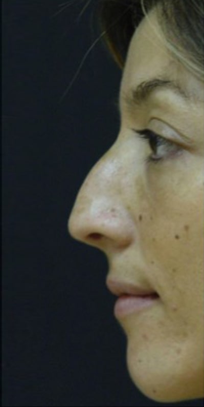 Female patient before Nonsurgical Rhinoplasty