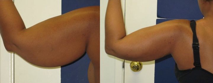 Female patient's left arm before and after arms liposuction