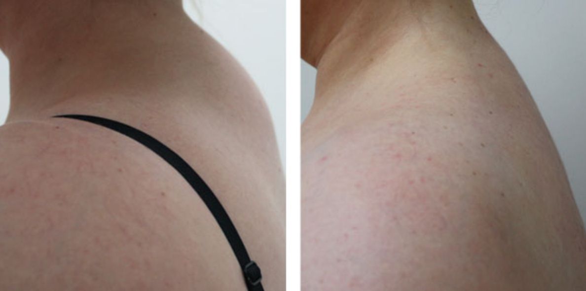 Patient's neck before and after buffalo hump liposuction.