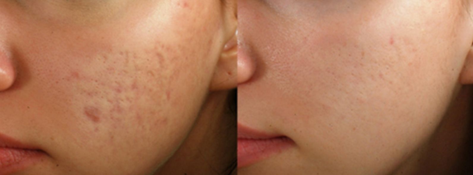 Female patient's face before and after Microneedling treatment