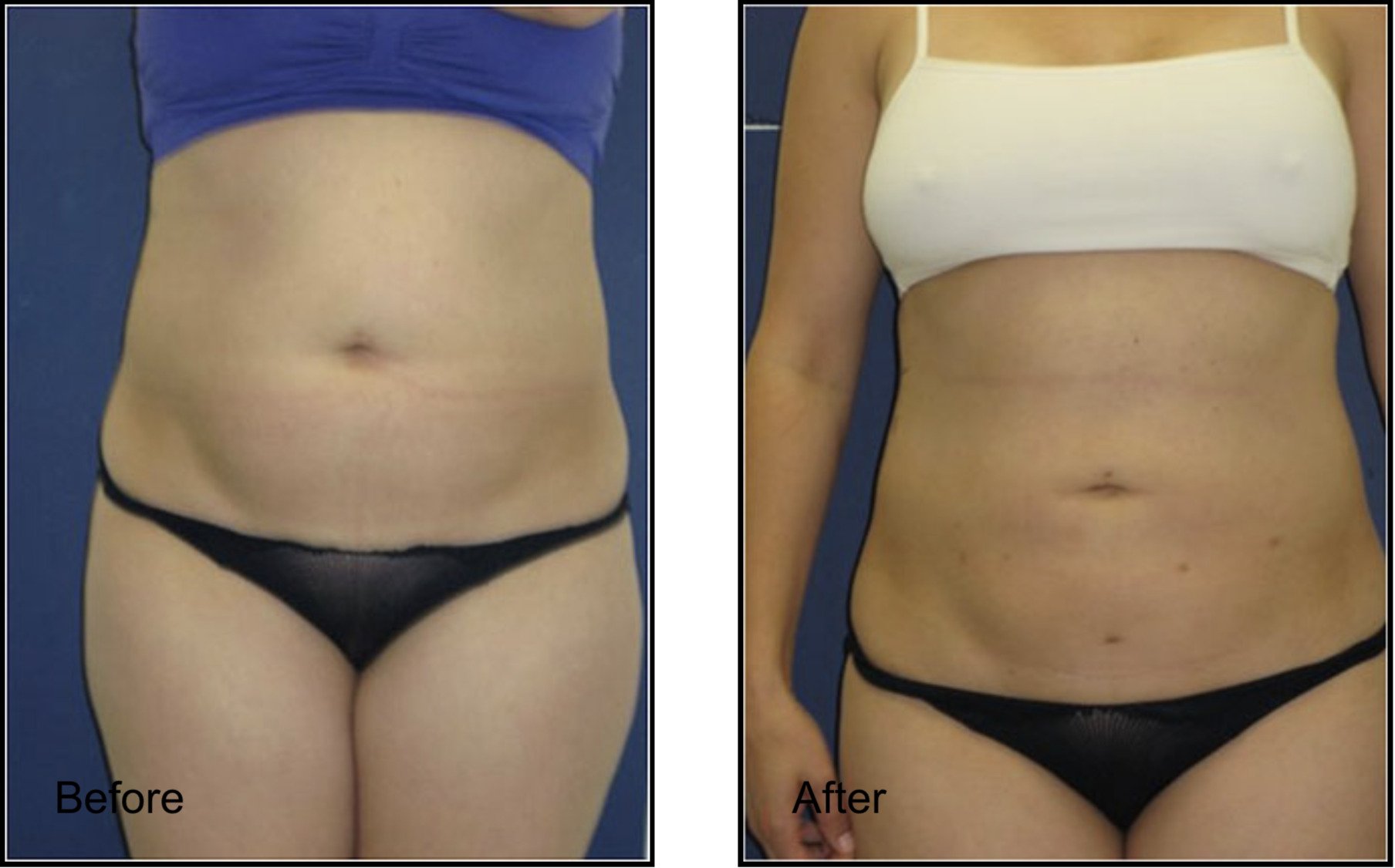 Female patient before and after love handles lipo