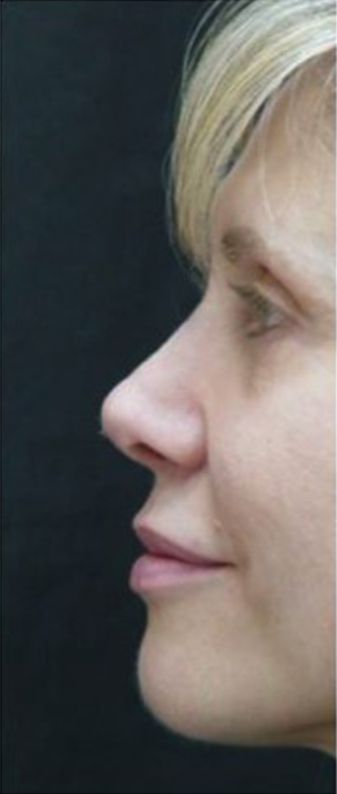 Patient after Nonsurgical Rhinoplasty