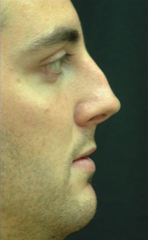 Male patient before Nonsurgical Rhinoplasty