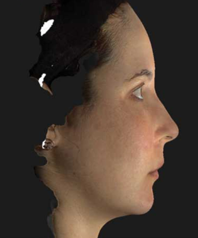 Patient after Neurotox Nefertiti Lower Facelift