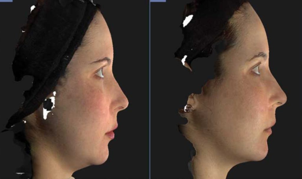 Los Angeles Nefertiti Neck/Lower Face Lift With Neurotox® | Beverly Hills