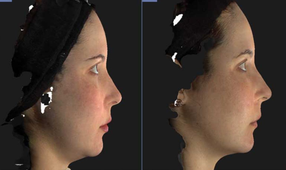 Female patient before and after Botox® Nefertiti Lower Facelift