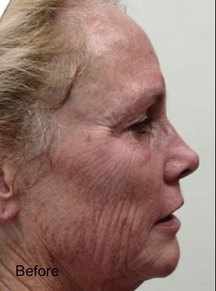 Patient before CO2 laser Skin Resurface Treatment