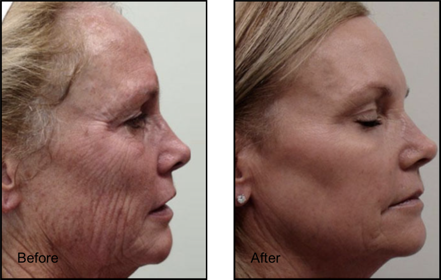 Female patient's face before and after CO2 laser skin resurfacing