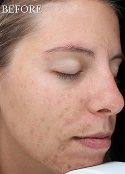 Patient before Chemical Peels