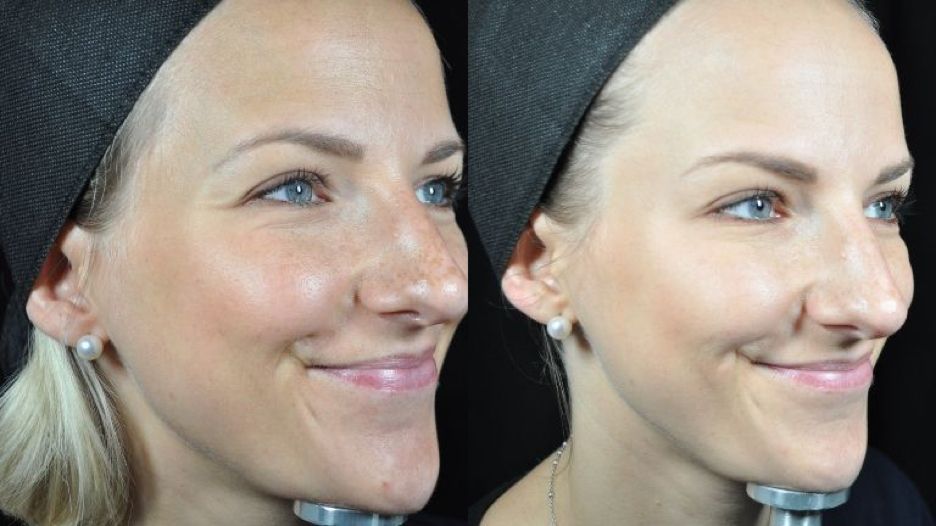 Female patient before and after baby botox treatment