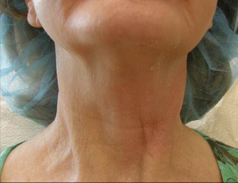 Patient before Relift Skin Tightening and Fat Melting Lower Face